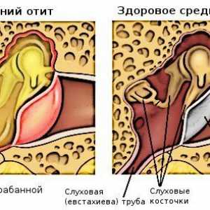Zánět středního ucha: příznaky a léčba