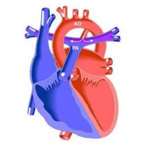 Otevřené arteriální arteriální kanál (CAP): způsobuje rozštěp u dětí, příznaky, jak zacházet