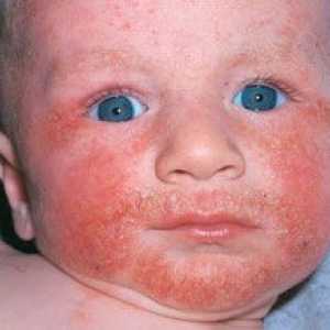 Potravinové alergie u dětí