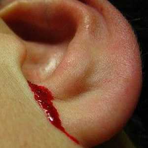 Proč je krvácení z ucha