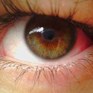 Proč praskla kapilár v očích? Příčiny a prevence