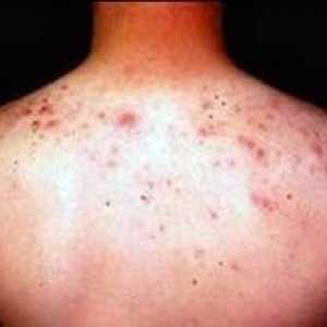 Co způsobuje akné na zádech a ramenou?