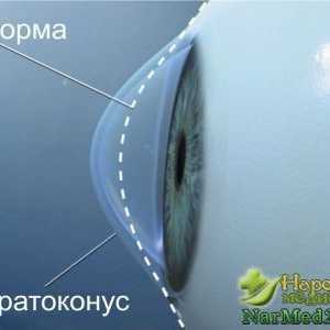 Vznik keratoconus očí a způsoby, jak ji eliminovat