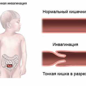 Následky střevní obstrukce u kojenců