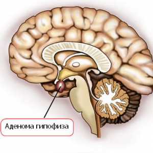 Jaké jsou příznaky adenomu hypofýzy