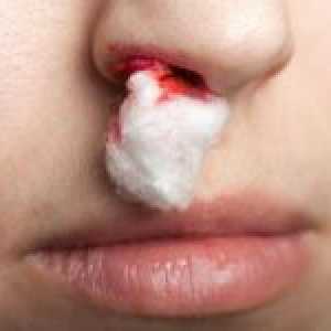 Příčiny časté krvácení z nosu a způsoby zastavení