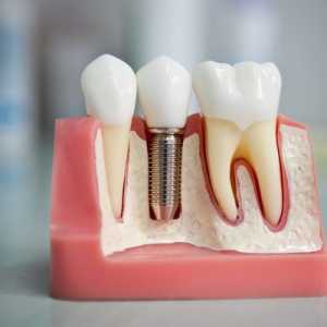 Příčiny a léčba edému po implantaci zubů