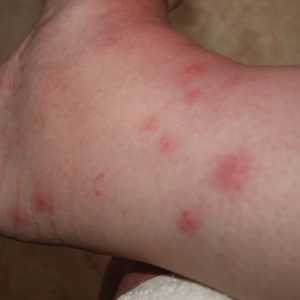 Příčiny edému v alergie a jak je řešit