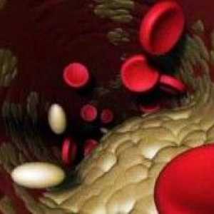 Příčiny vysoké hladiny cholesterolu v krvi - jak je třeba léčit? Lidových prostředků jsou silné?