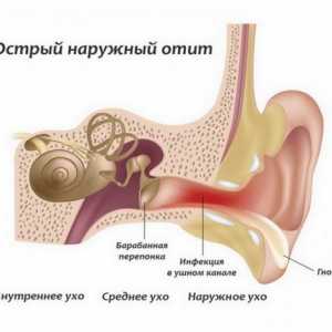 Příčiny těchto příznaků a léčba zánětu středního ucha do ucha