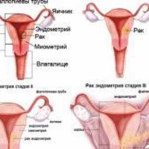 Příčiny a léčba hyperplazie endometria dělohy