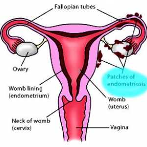 Příčiny endometriózy, děložní - zvážit všechny teorie