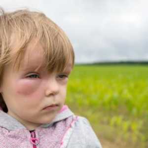 Pomoc při anafylaktického šoku u dětí