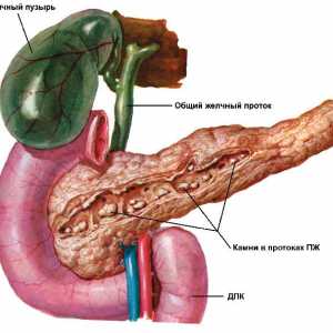 Známky a příznaky pankreatitidy u žen