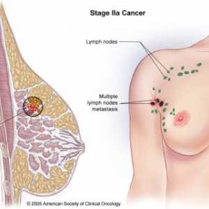 Karcinom prsu (mléčná žláza)
