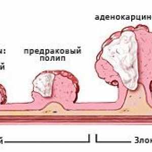 Symptomatologie rakoviny tlustého střeva u mužů