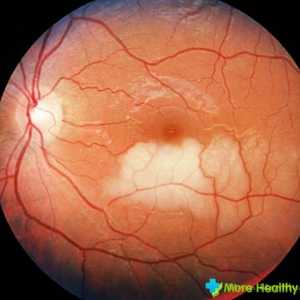 Stratifikace sítnice očí: příčiny a důsledky