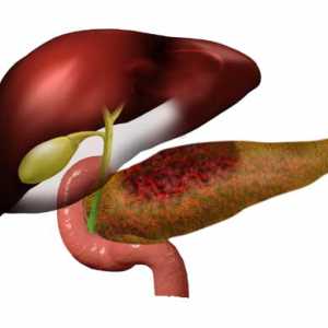 Příznaky a léčba alkoholického pankreatitida