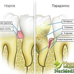 Recepty, jak se zbavit onemocnění parodontu na základě lidových prostředků