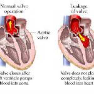 Aortální regurgitace ventil