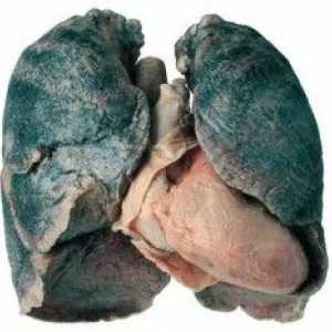 Plicní sarkoidóza
