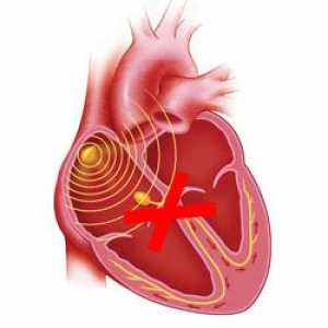 Srdeční blok: úplné nebo částečné, různé lokality - příčiny, příznaky, léčba