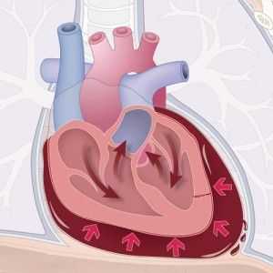 Srdeční tamponáda: symptomy, diagnostika, první pomoc, léčba