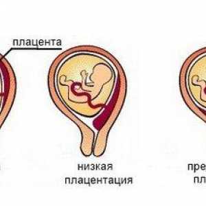 Příznaky a diagnóza low placentace