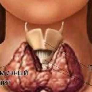 Příznaky a léčení autoimunitní thyroiditis