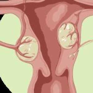 Příznaky a léčba intersticiálních subserous děložních myomů
