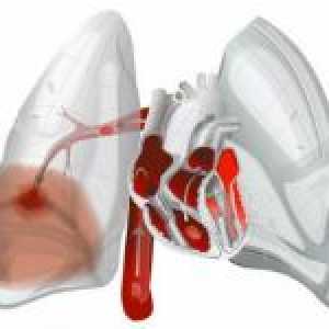Plicní embolie (PE)