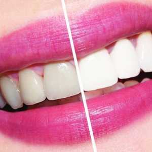 Kolik bělení zubů v zubním lékařství?