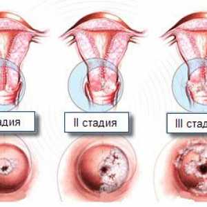 Spondylóza bederní páteře
