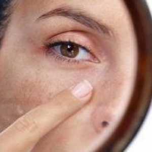 Senilní pigmentové skvrny na obličeji: Jak se zbavit