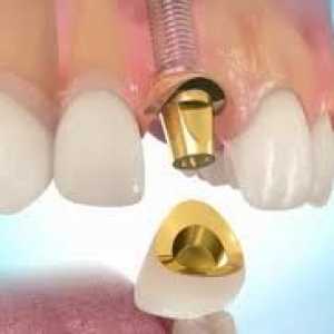 Náklady na zubní implantáty, stejně jako jejich názory