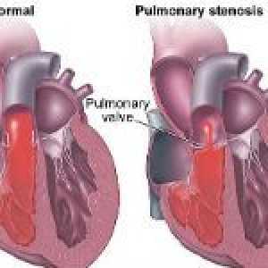 Zúžení plicní ventilu