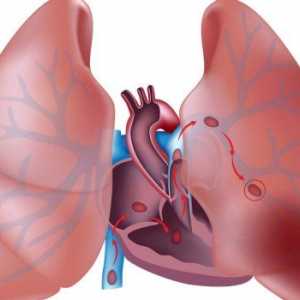 Embolie a trombóza plicnice