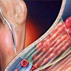 Trombóza hlubokých žil dolních končetin a jejich léčení