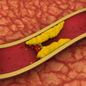 Trombóza vnitřních žil v těle