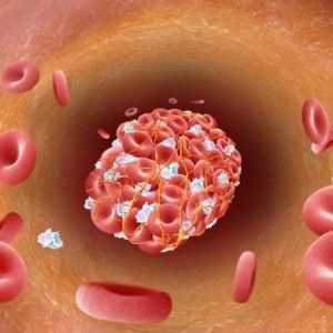 Krevní sraženiny v cévách: tepny a žíly - příčiny, léčba, lokalizace