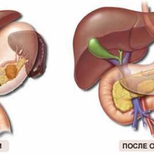 Odstranění pankreatu