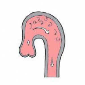 Pečeť aorty (ventil letáky, kořen oblouku): symptomy, příčiny, jak léčit