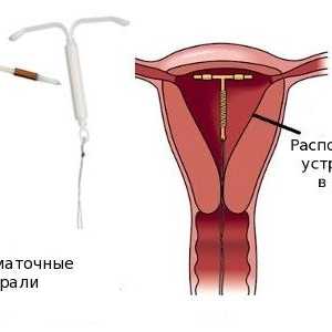 Instalace IUD po porodu