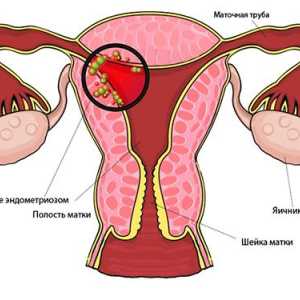 Gynekolog Tipy: když dělat ultrazvuk endometriózy