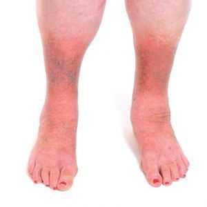 Křečové ekzém (dermatitida) dolních končetin: příčiny, příznaky, léčba