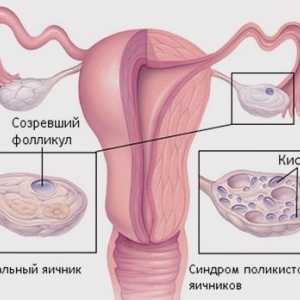 Důležitou otázkou pro mnoho žen: jak vyléčit syndromem polycystických vaječníků?