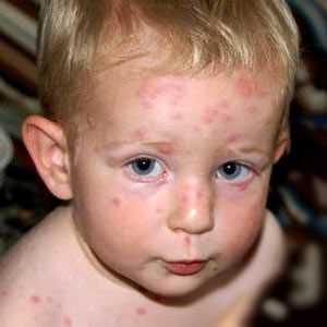 Plané neštovice u dětí
