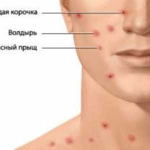 Varicella (plané neštovice) u dospělých