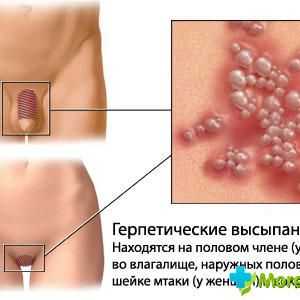 Puchýře na stydkých (genitální herpes)