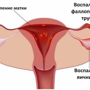 Zánět vaječníků nebo adnexitidy
